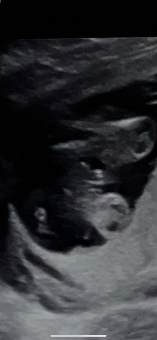 GENDER BABY 18 week