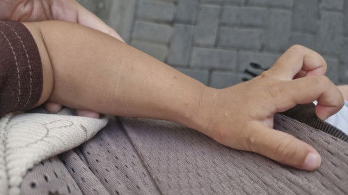 Baby 17bulan muncul bintik2 spt jerawat dan berair di telapak tgn dan kaki