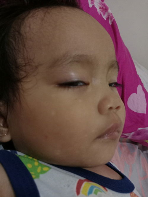 Bercak Putih pada wajah si kecil