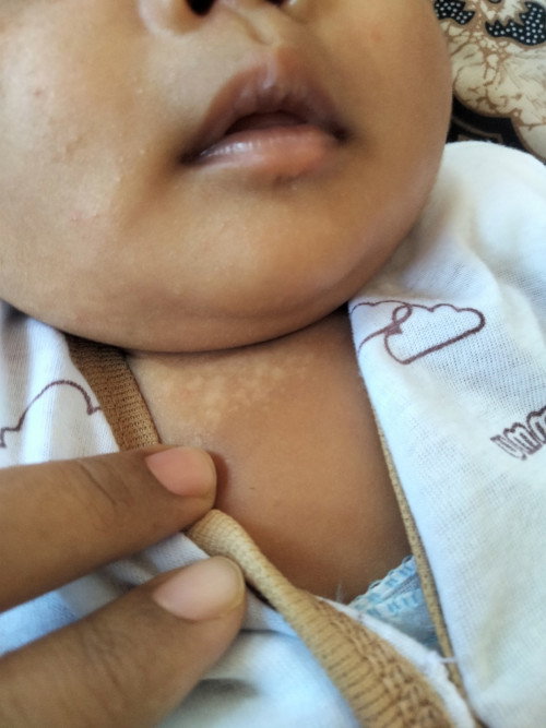 Leher bayi putih seperti panu