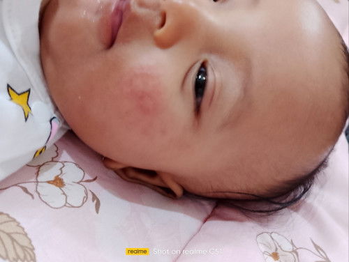ruam pipi
