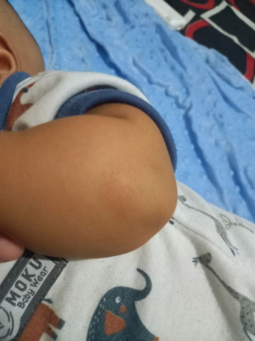 Chiken skin atau bukan