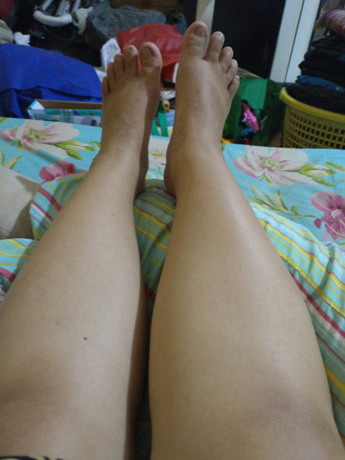 Usia kehamilan 24 mgg, cara meredakan kaki bengkak. Tapi, gak oedema protein urin (-) Tensi normal.