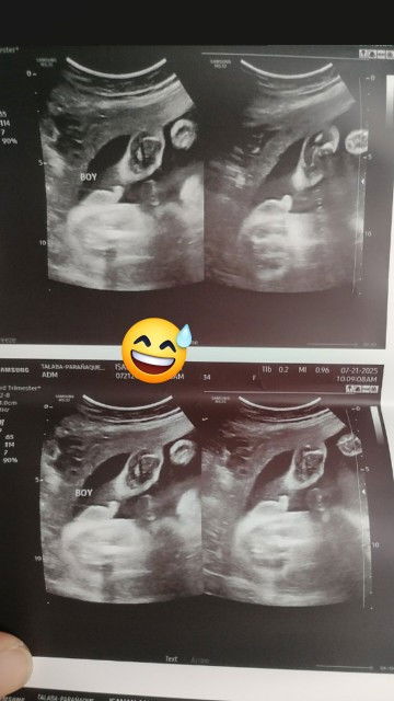 Ultrasound