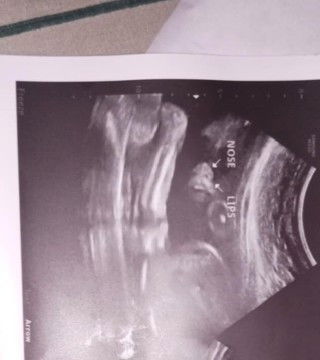 hello po, normal lang po kaya yung ganitong nose and lips ni baby?