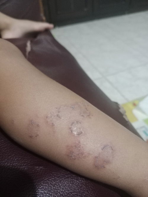 Apakah ada krim penghilang atau pemudar bekas luka ?