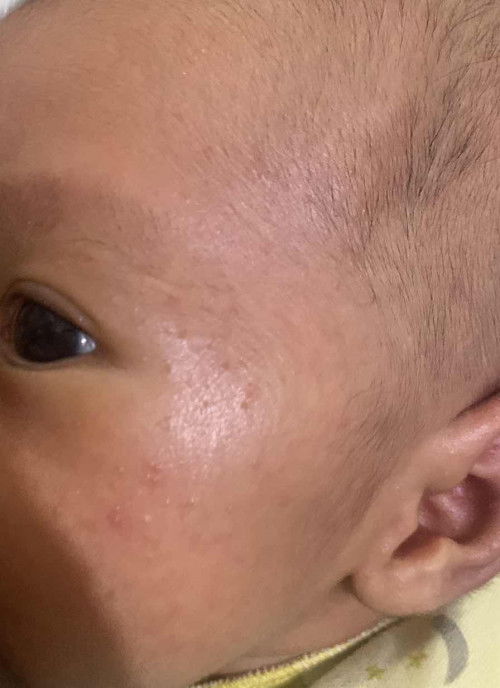 Bintil2 merah di wajah dan kepala bayi