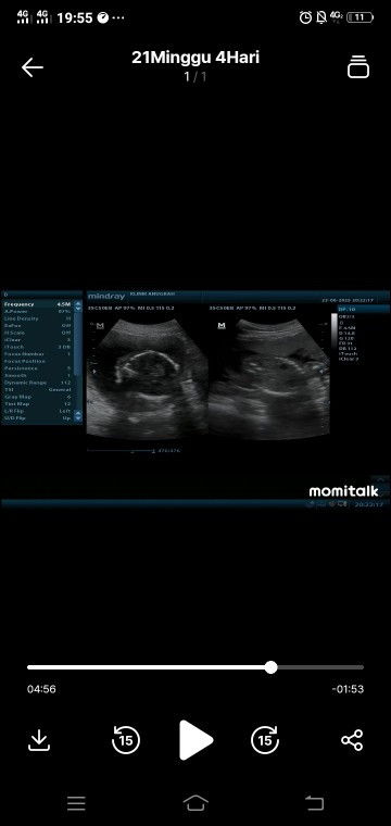 Usg 21weeks&25weeks