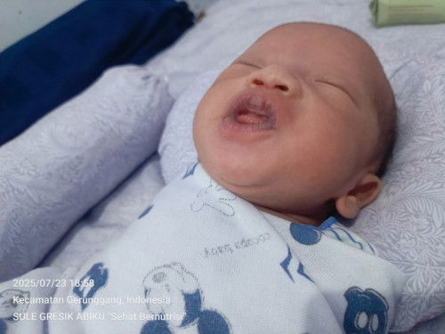 Bibir anak bagian atas sedikit mengeras dan kering