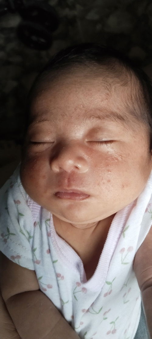 Mga mii, ano po nilagay nyo para mapawala ng mabilis ang acne ng baby nio?