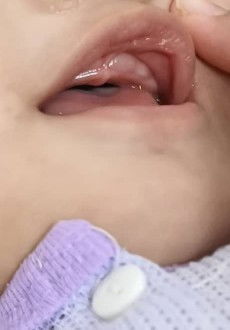 Anak sudah 8bulan. Adakah ini Gigi mahu tumbuh? Sebab di bawah belum ada Gigi.