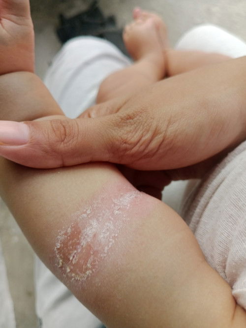 kulit bayi sensitif