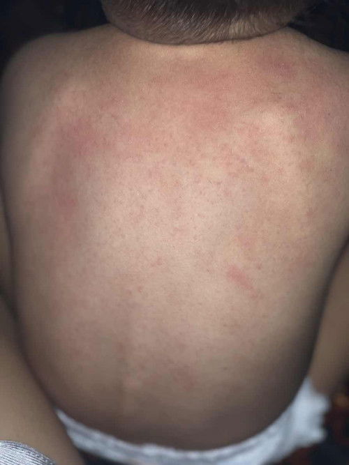 Adakah yg pernah tes Alergi pada Anak