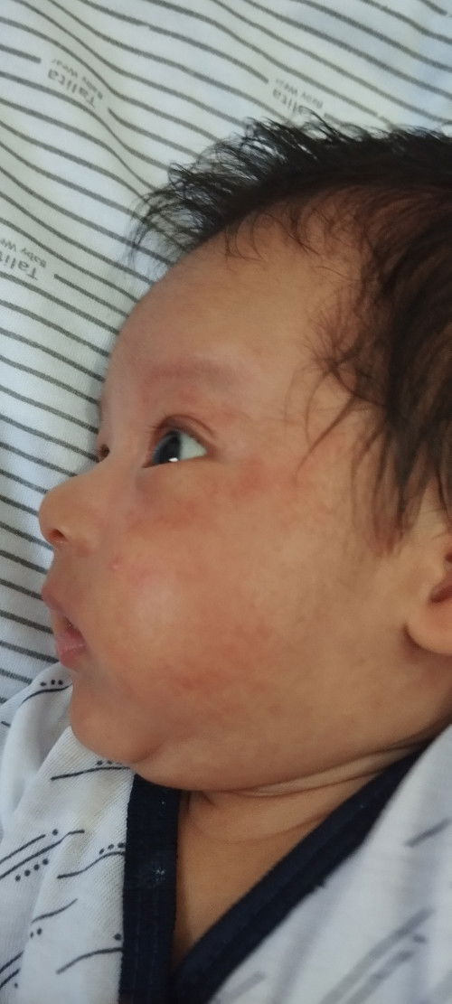 Merah di wajah bayi