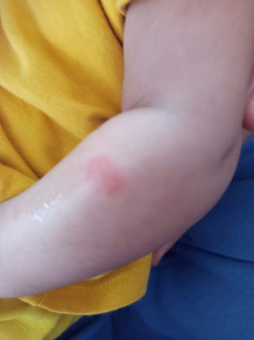 Kulit bayi 3 bulan kemerahan