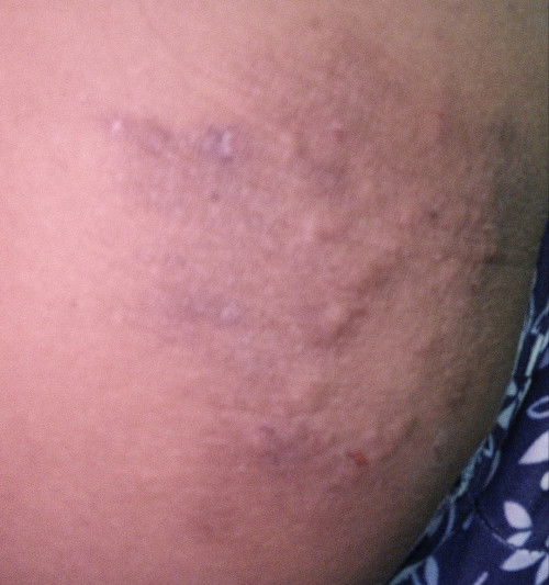 pregnancy rash?