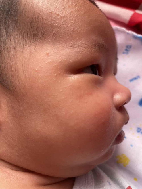 น้องมีผื่นผดและผื่นแดง