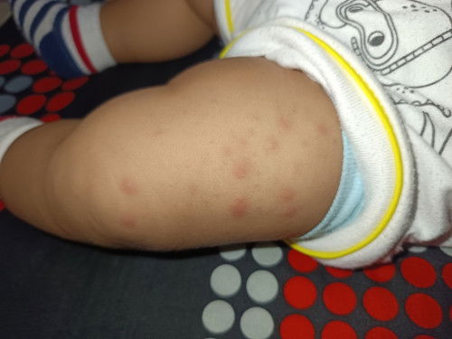 Bintik Merah Kulit Bayi