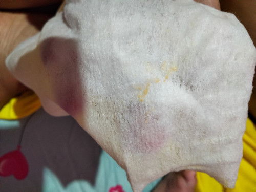Lendir kuning di vagina bayi