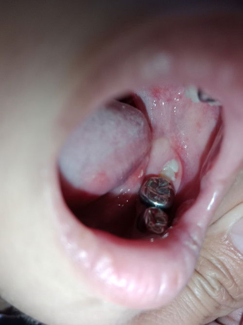 early emerging of Wisdom teeth