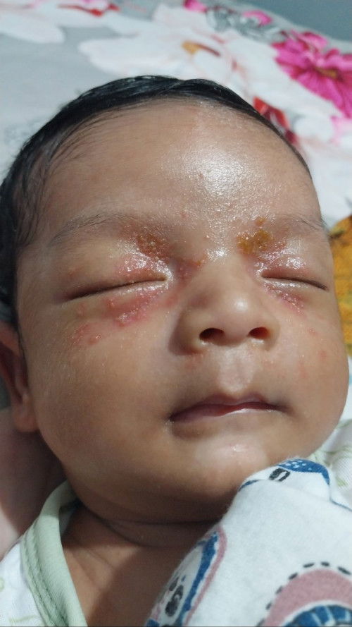 Gatal atau jerawat newborn