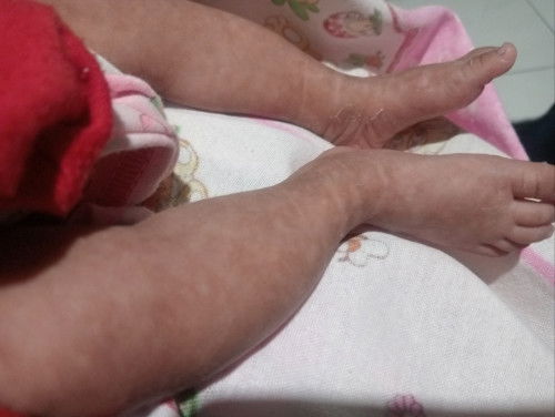 Ini Kulit kaki dan tangan anak q usia 27 hari jd belang2 coklat + putih.. kira2 knp ya?