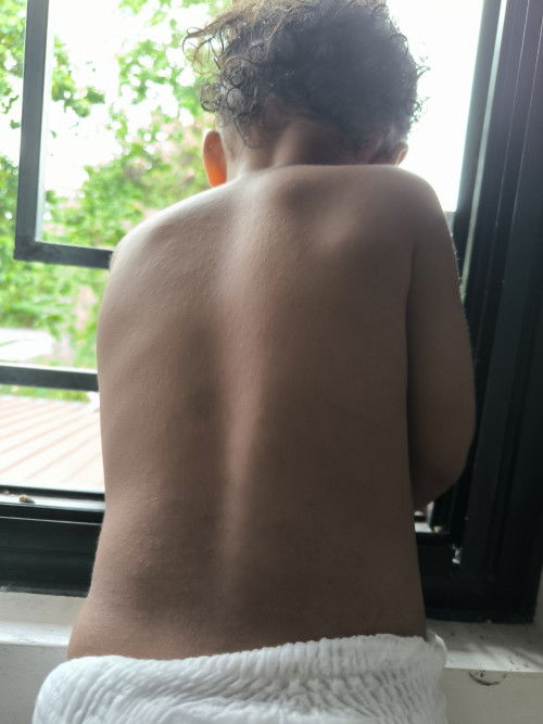 Small bumps on the back toddler