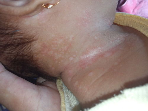 Ruam merah di leher bayi