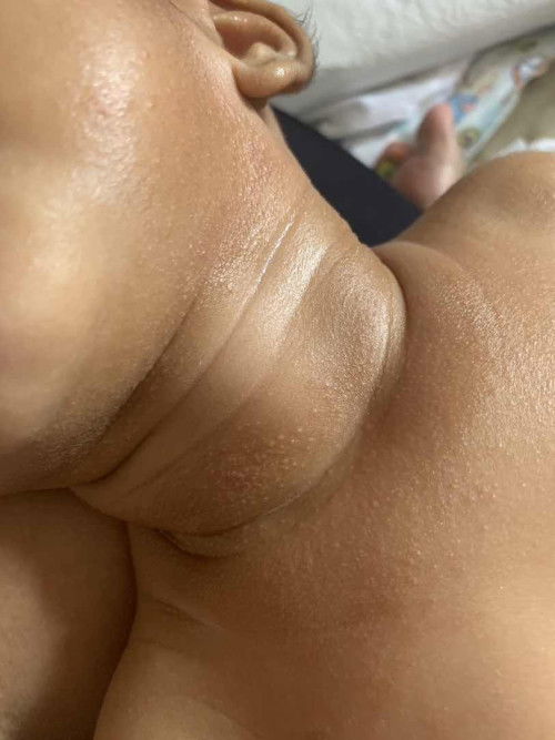 Ruam atau eczema?