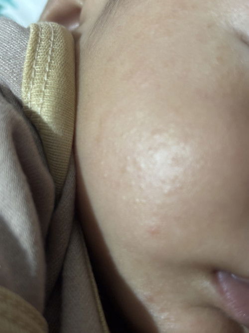 Bintik2 kasar dimuka bayi