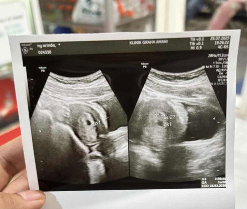 Hasil USG 5 week 4 day