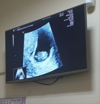 Tidak berkembang di usia 11 minggu