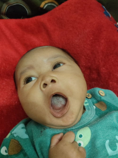 Lidah bayi putih
