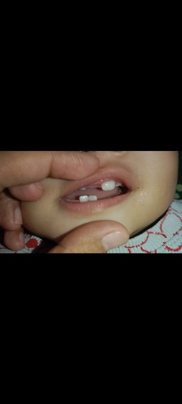 Normal lang ba tubo ng ngipin ng baby ko mas nauna kc lumabas yung dalawa gilid sa taas bago gitna