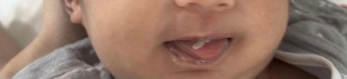 ริบฝีปากลูกเป็นแบบนี้ คืออะไรคะ ดูดนมได้ปกติ