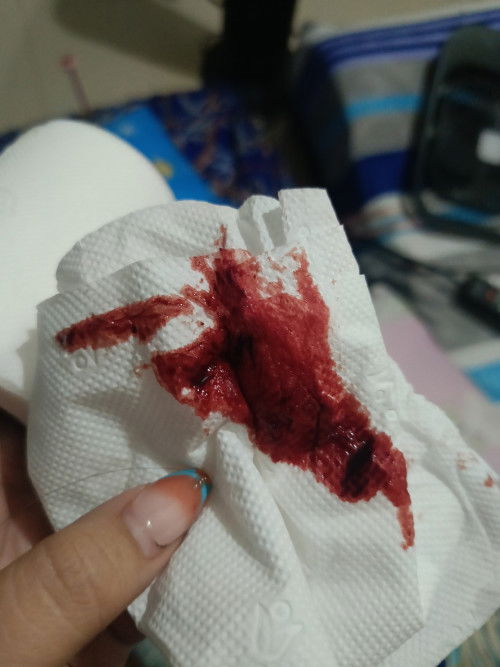 Subchorionic hemorrhage