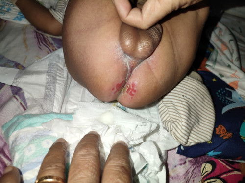 Merah merah pada dubur bayi