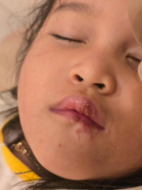 Luka sekitar bibir