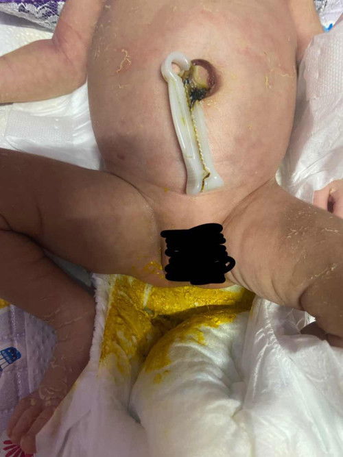 TW ⚠️ Jaundice dan tips ?
