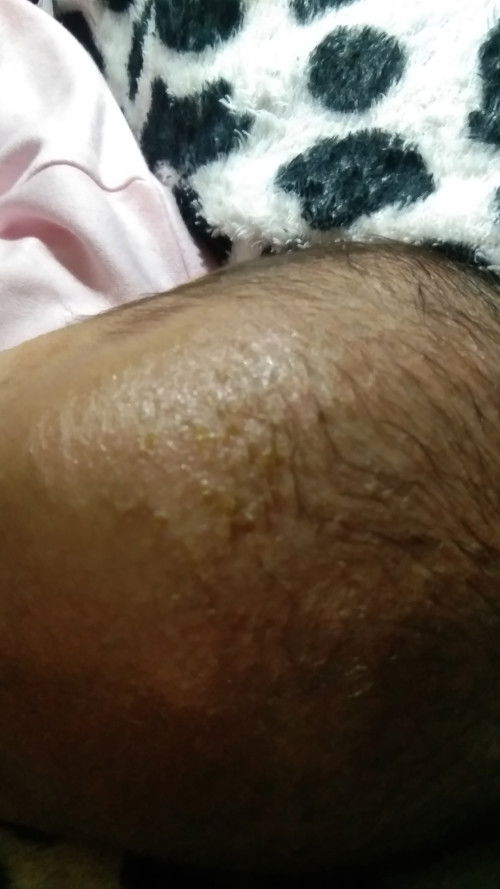 bund kalo muncul kulit kerak kekuningan di area kepala sama wajah pake apa ya?