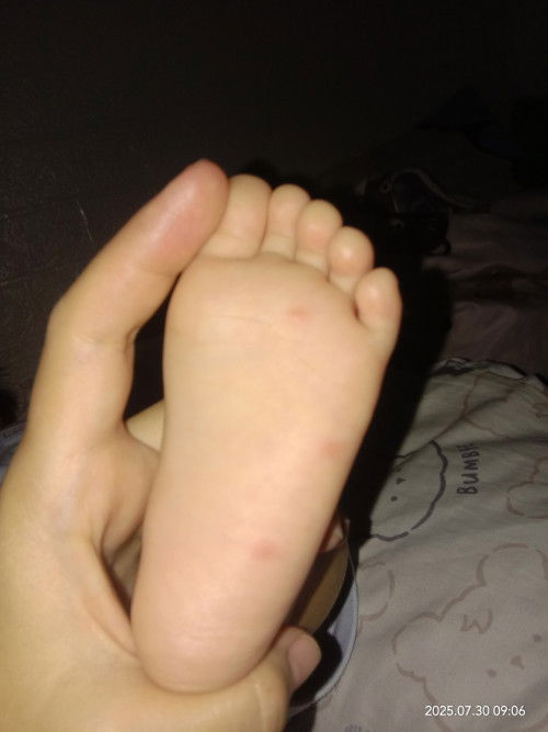 Bentol bentol pada kulit bayi