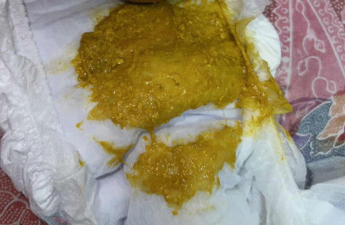 Baby berak cirit @ normal