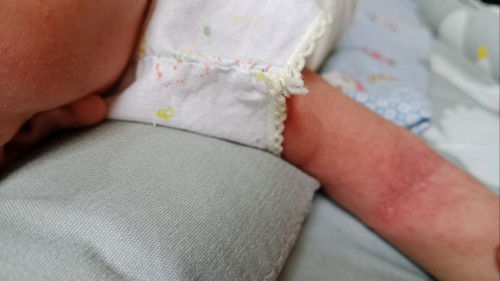 Badan bayi bintik bintik merah