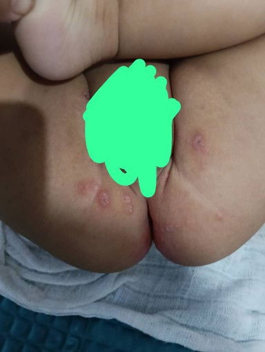 Hello, ni sebab ruam pampers ka? Atau tidak sesuai pampers? Ni ruam saja ka? Suggest cream yg bagus