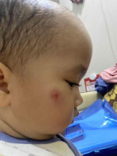Anak saya suka tiba2 bentol seperti ini dan selalu lebih dari 3 titik ,gatega liatnyaa,kenapa ya