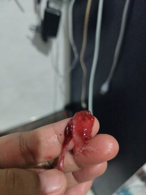 Ini apa ya bun aku haid hari ke 2 tadi pipis keluar ini seperti gajih lemak