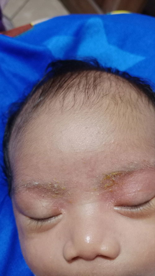Maaf mau nanya, ini anak qu knp yh.. 
Trus obatnya apa? 
Apakah bisa sembuh kmbali 
Obat apa yhh