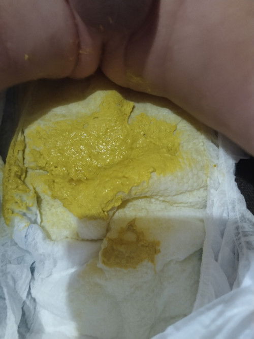 Simula kagabi Hanggang ngayon Umaga naka 3 poops si baby dilaw sya na basa konti diarrhea na ba yon?