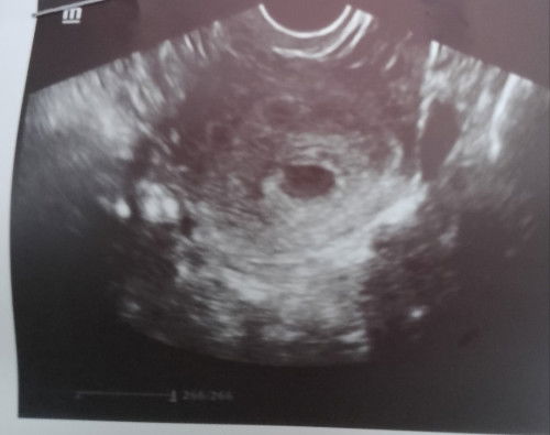 PREGNANCY