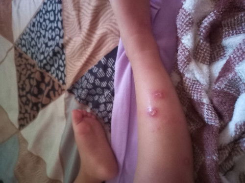 bentol bernanah seperti bisul